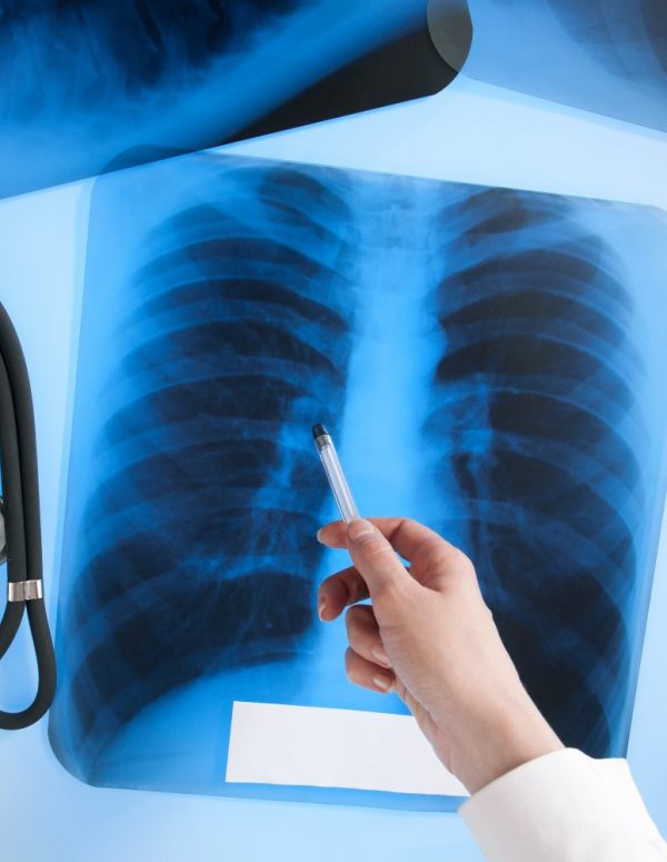 X-ray of the respiratory and skeletal system after Covid-19